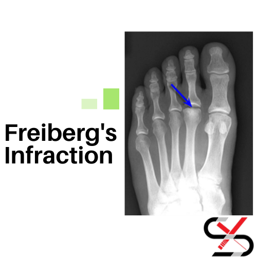 Freiberg’s Infarction